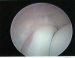 elbow normal rc joint